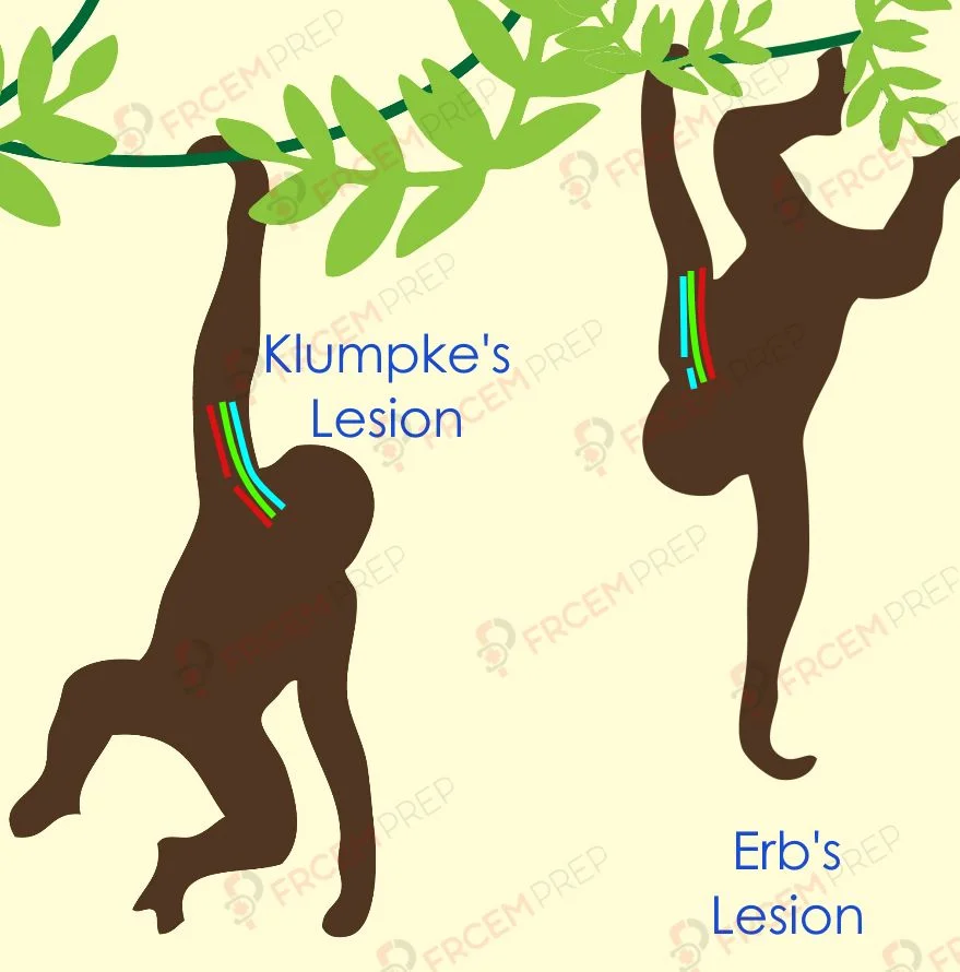 Erb's and Klumpke's palsy illustration