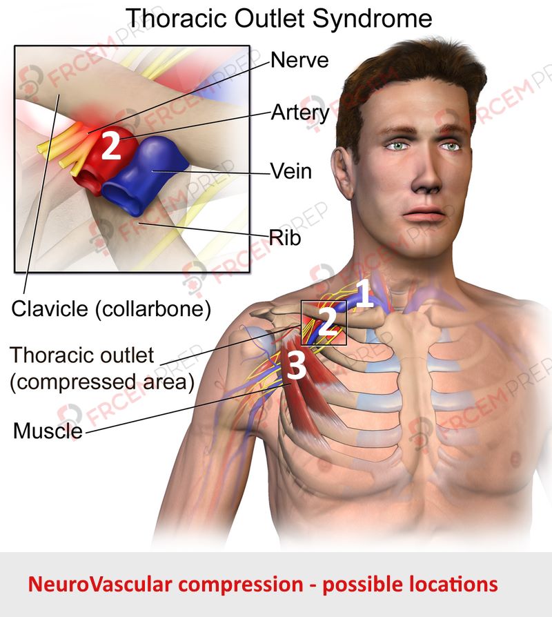 Thoracic outlet syndrome possible locations of compression.